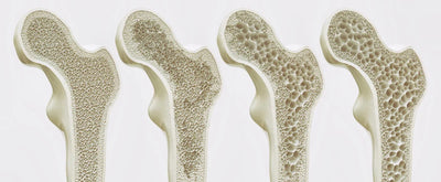 Osteoporose und Wechseljahre